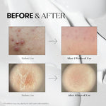 CICA Reedle Shot 100, Spicule Microneedling Serum for Pore Care & Exfoliation, Exosome, Centella Asiatica for Glass Skin, Skin Texture, Korean Liquid Skin Booster (1.69 Fl Oz / 50Ml)