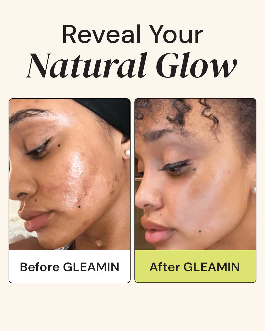 Before and after comparison of a woman using Superactive Serum, showing improved skin clarity and glow from Vitamin C and brightening ingredients.