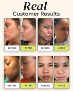 Before and after results of Superactive Serum showing reduced dark spots and clearer skin on real customers, Vitamin C serum for discoloration.