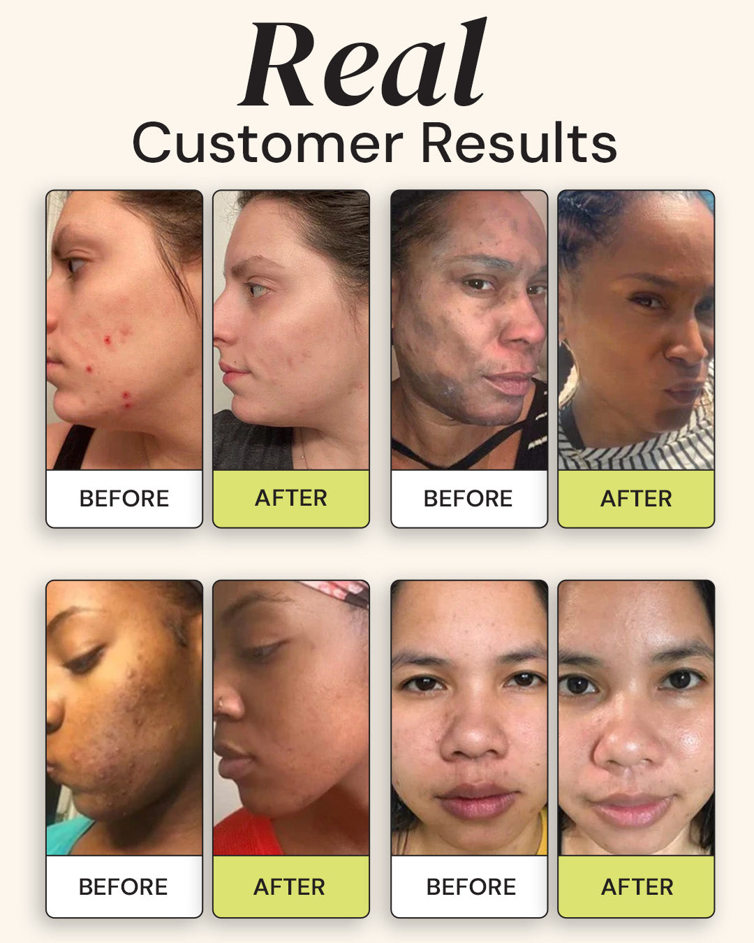 Before and after results of Superactive Serum showing reduced dark spots and clearer skin on real customers, Vitamin C serum for discoloration.