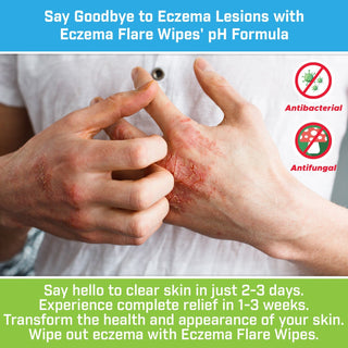 Eczema Flare Wipes® pH Select